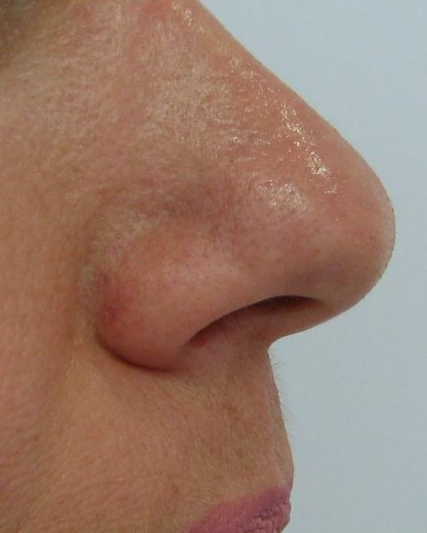 Deset dni po odstranitvi fibroma