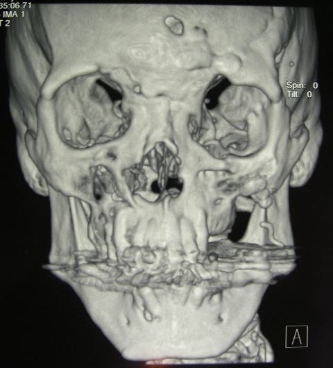 3D-rekonstrukcija CT-posnetkov obraznega skeleta