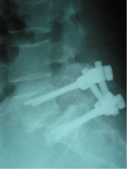 Stranski rentgenski posnetek stanja po operacijskem zdravljenju spondilolitične spondilolisteze petega ledvenega vretenca