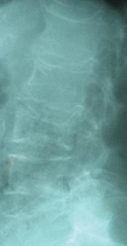 Rentgenogram ledvene hrbtenice v stranski projekciji. Jasni znaki osteoporoze z zlomi teles vretenc pri 65-letni ženski