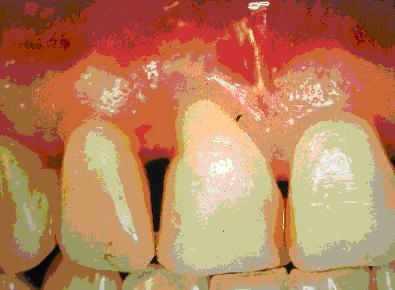 Pobarvana mehka zobna obloga na zobeh pri isti osebi kot na sliki 1